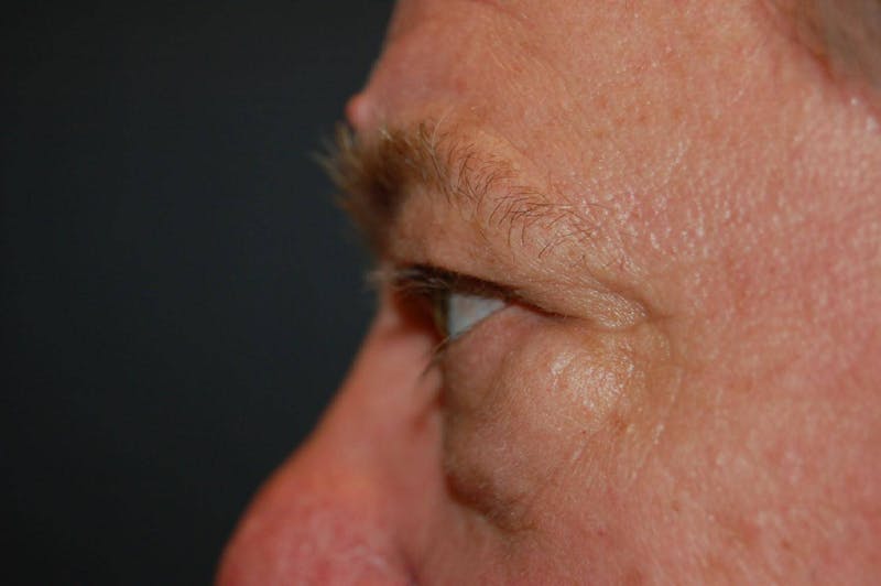 Blepharoplasty Before & After Gallery - Patient 36535133 - Image 3