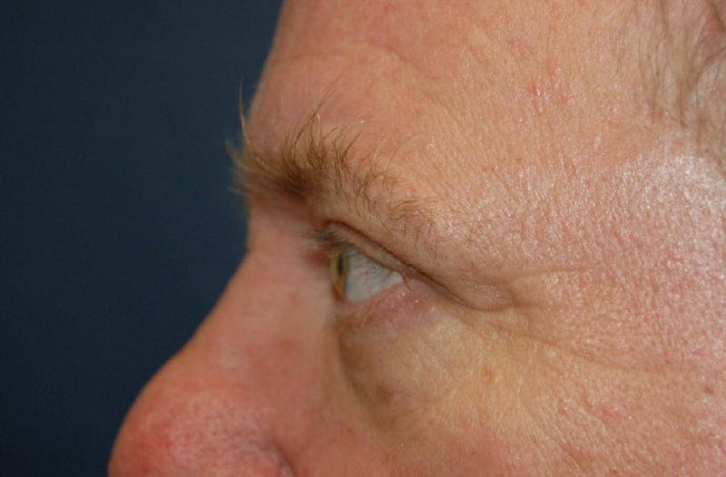 Blepharoplasty Before & After Gallery - Patient 36535133 - Image 4