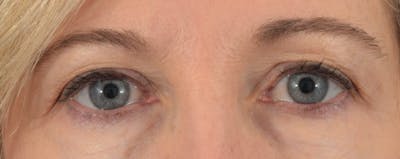 Blepharoplasty Before & After Gallery - Patient 36535134 - Image 1