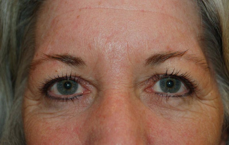 Dr. Frankel Eyelid Surgery 03