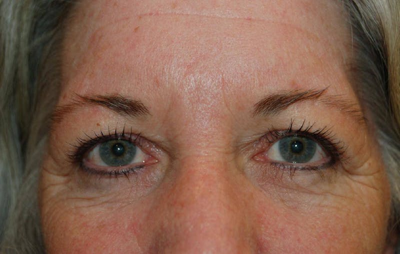 Blepharoplasty Before & After Gallery - Patient 36535135 - Image 1