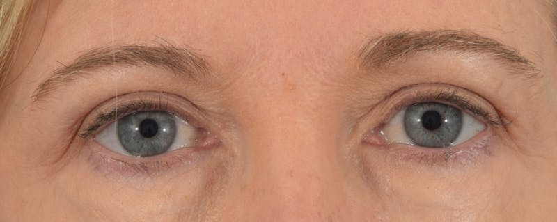 Blepharoplasty Before & After Gallery - Patient 36535134 - Image 2