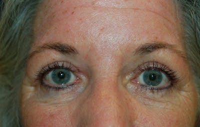 Blepharoplasty Before & After Gallery - Patient 36535135 - Image 2