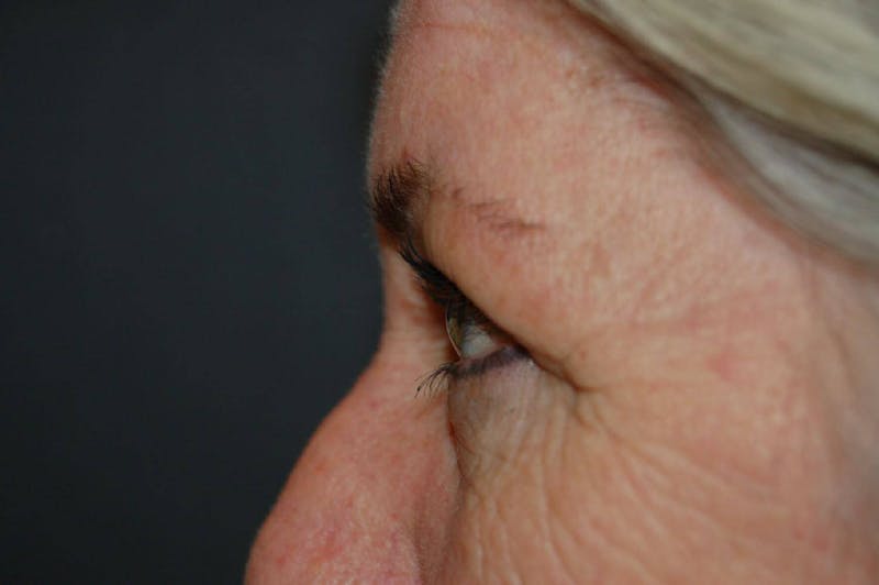 Blepharoplasty Before & After Gallery - Patient 36535135 - Image 3