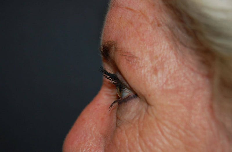 Blepharoplasty Before & After Gallery - Patient 36535135 - Image 4