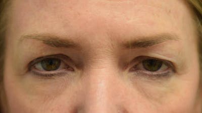 Blepharoplasty Before & After Gallery - Patient 36535136 - Image 1