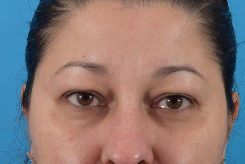 Blepharoplasty Before & After Gallery - Patient 36535137 - Image 1