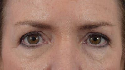 Blepharoplasty Before & After Gallery - Patient 36535136 - Image 2