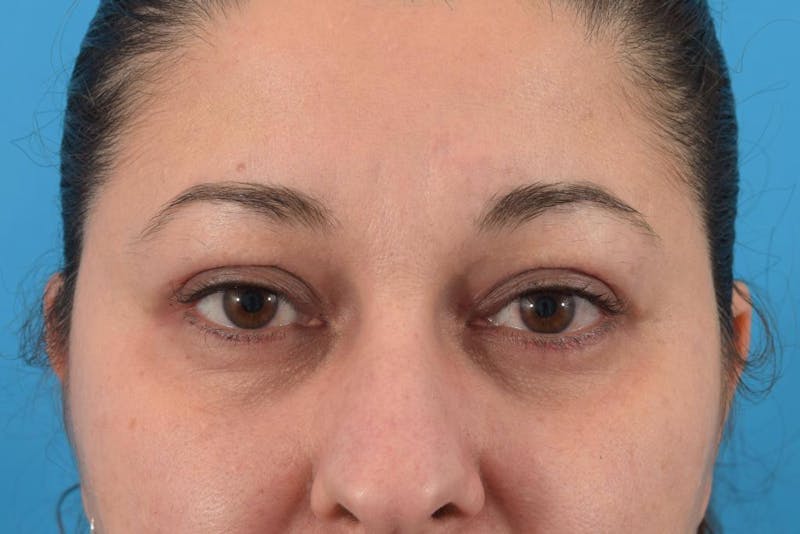 Blepharoplasty Before & After Gallery - Patient 36535137 - Image 2