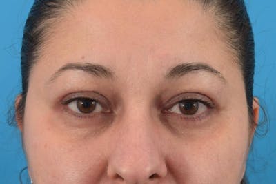 Blepharoplasty Before & After Gallery - Patient 36535137 - Image 2