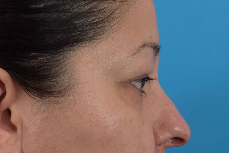 Blepharoplasty Before & After Gallery - Patient 36535137 - Image 3