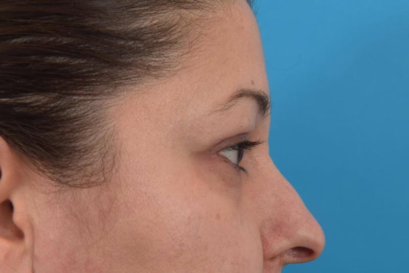 Blepharoplasty Before & After Gallery - Patient 36535137 - Image 4