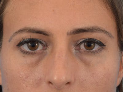 Blepharoplasty Before & After Gallery - Patient 36535138 - Image 1