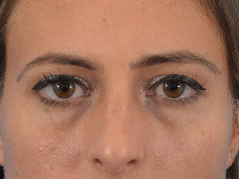 Blepharoplasty Before & After Gallery - Patient 36535138 - Image 1