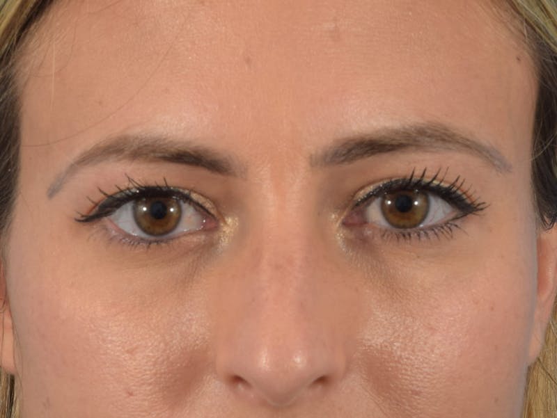 Blepharoplasty Before & After Gallery - Patient 36535138 - Image 2