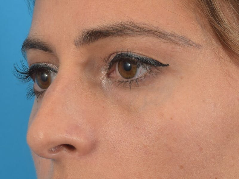Blepharoplasty Before & After Gallery - Patient 36535138 - Image 3