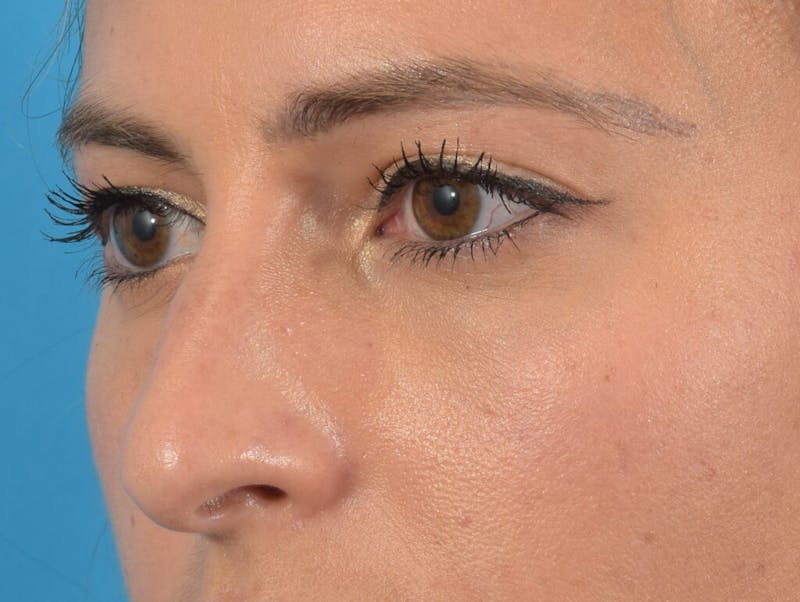Blepharoplasty Before & After Gallery - Patient 36535138 - Image 4