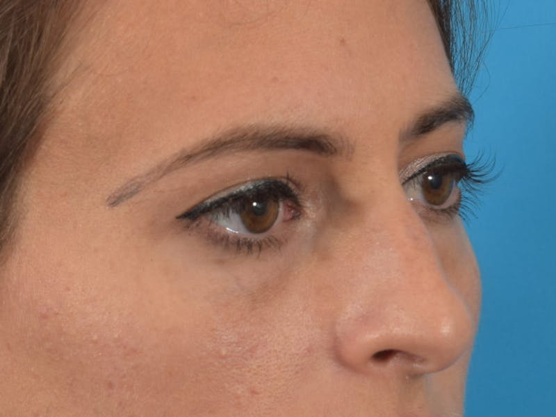 Blepharoplasty Before & After Gallery - Patient 36535138 - Image 5