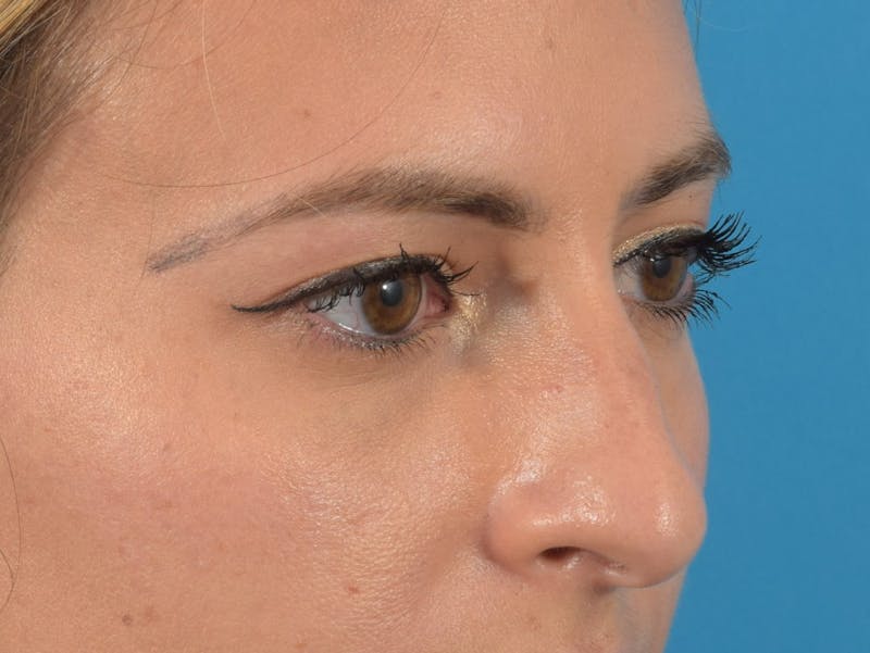 Blepharoplasty Before & After Gallery - Patient 36535138 - Image 6