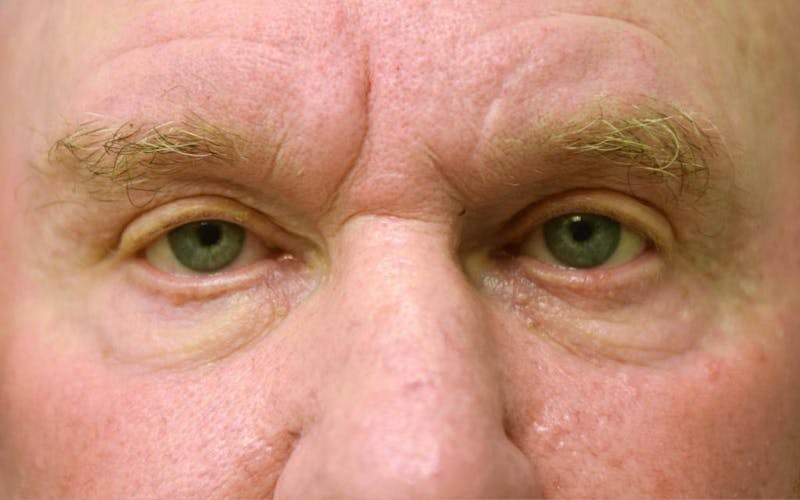 Blepharoplasty Before & After Gallery - Patient 57583729 - Image 1