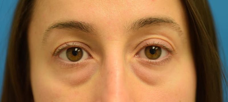 Blepharoplasty Before & After Gallery - Patient 57583730 - Image 1