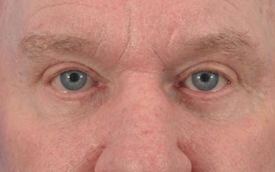 Blepharoplasty Before & After Gallery - Patient 57583729 - Image 2