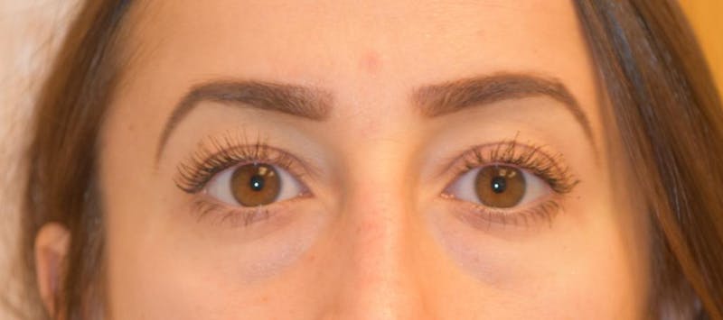 Blepharoplasty Before & After Gallery - Patient 57583730 - Image 2