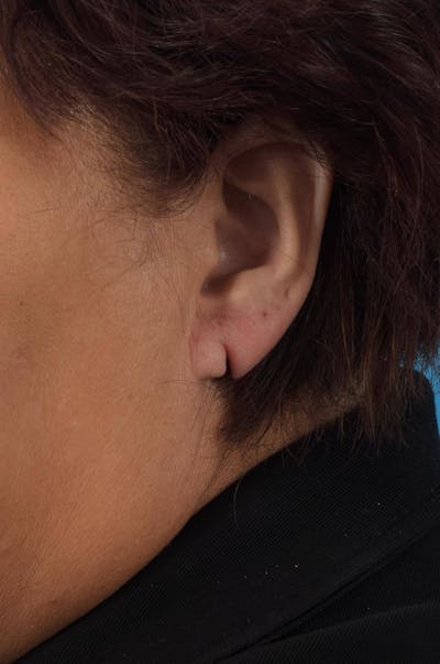 Earlobe Repair Before & After Gallery - Patient 36543093 - Image 1