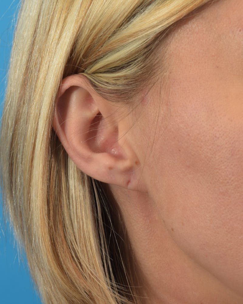 Earlobe Repair Before & After Gallery - Patient 36543094 - Image 1