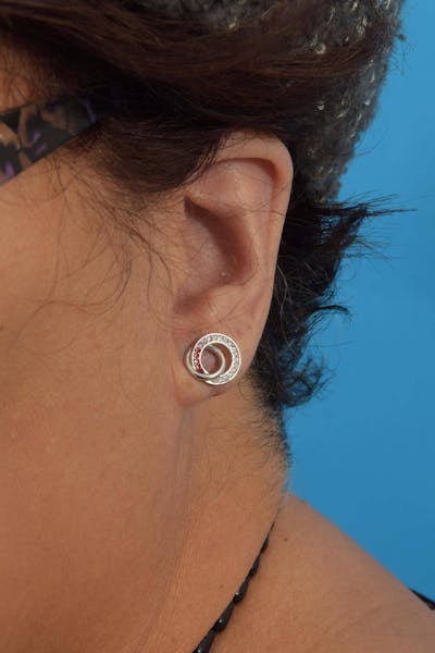 Earlobe Repair Before & After Gallery - Patient 36543093 - Image 2