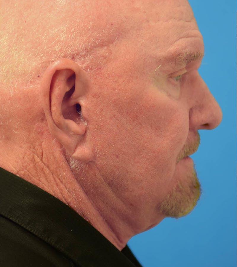Facelift/Neck Lift Before & After Gallery - Patient 36543113 - Image 1
