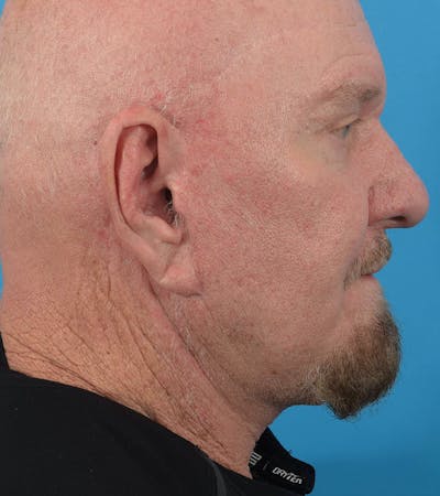 Facelift/Neck Lift Before & After Gallery - Patient 36543113 - Image 2