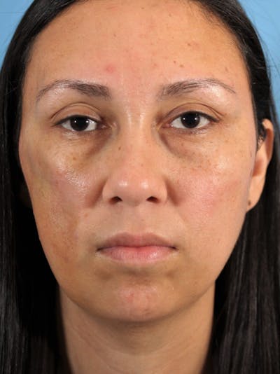 Fat Transfer Before & After Gallery - Patient 36543121 - Image 2