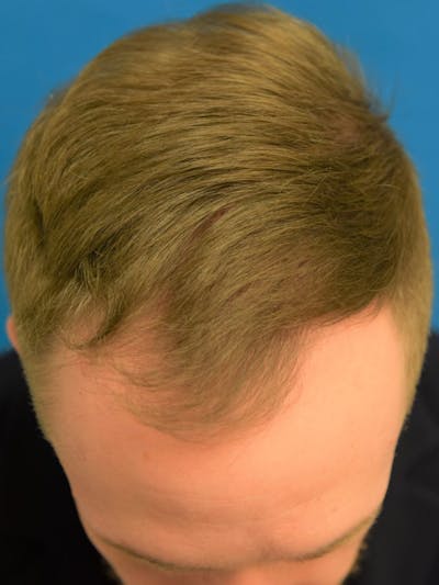 Hair Restoration Before & After Gallery - Patient 36543146 - Image 1