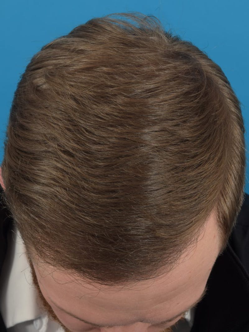Hair Restoration Before & After Gallery - Patient 36543146 - Image 2