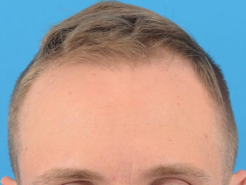 Hair Restoration Before & After Gallery - Patient 36543146 - Image 3