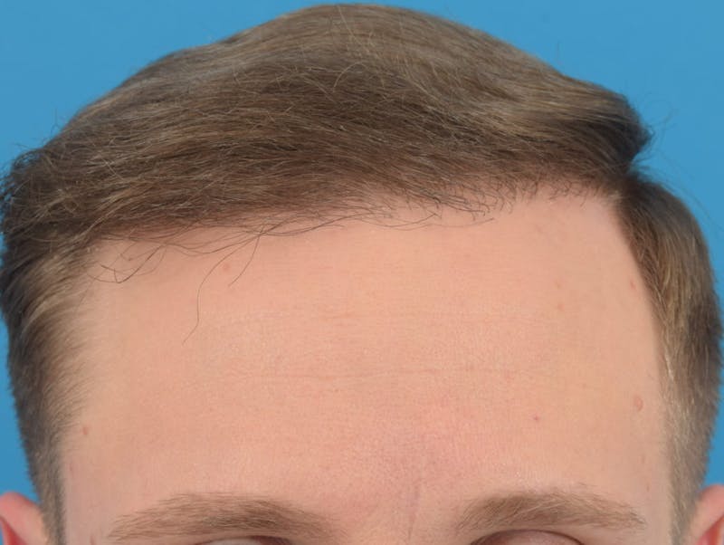 Hair Restoration Before & After Gallery - Patient 36543146 - Image 4