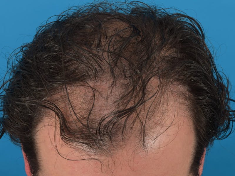 Hair Restoration Before & After Gallery - Patient 36543147 - Image 1
