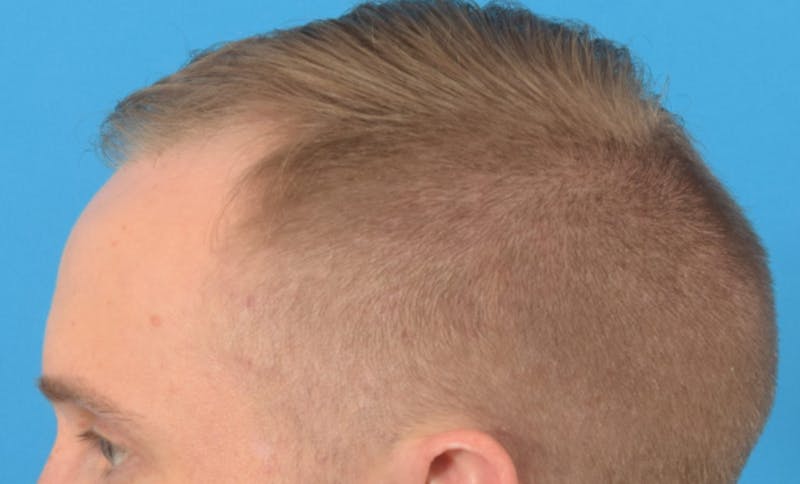 Hair Restoration Before & After Gallery - Patient 36543146 - Image 7