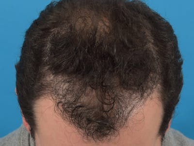 Hair Restoration Before & After Gallery - Patient 36543147 - Image 2