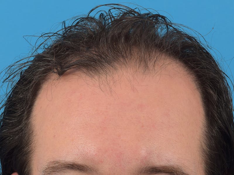 Hair Restoration Before & After Gallery - Patient 36543147 - Image 3