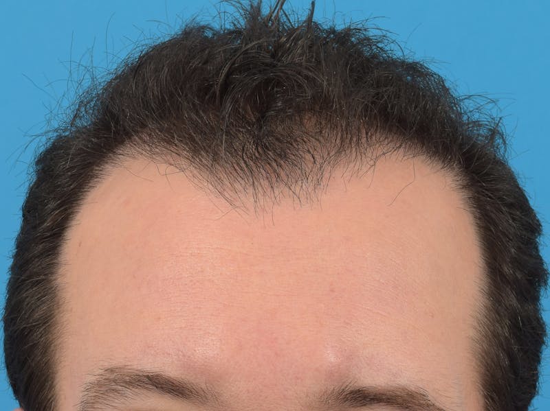 Hair Restoration Before & After Gallery - Patient 36543147 - Image 4