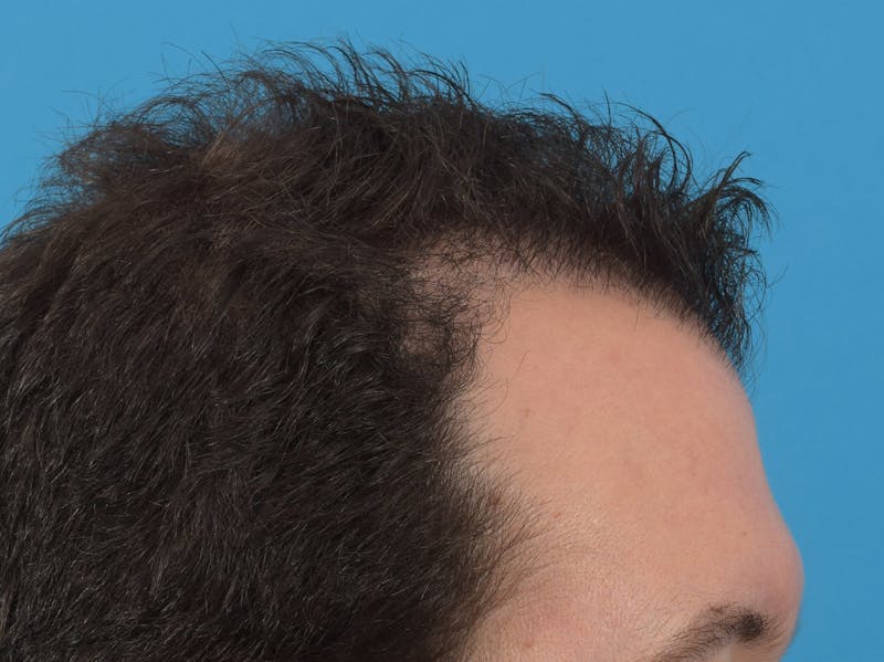 Hair Restoration Before & After Gallery - Patient 36543147 - Image 6