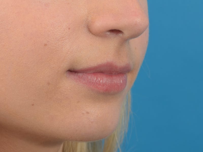 Filler - Lips Before & After Gallery - Patient 36543182 - Image 3