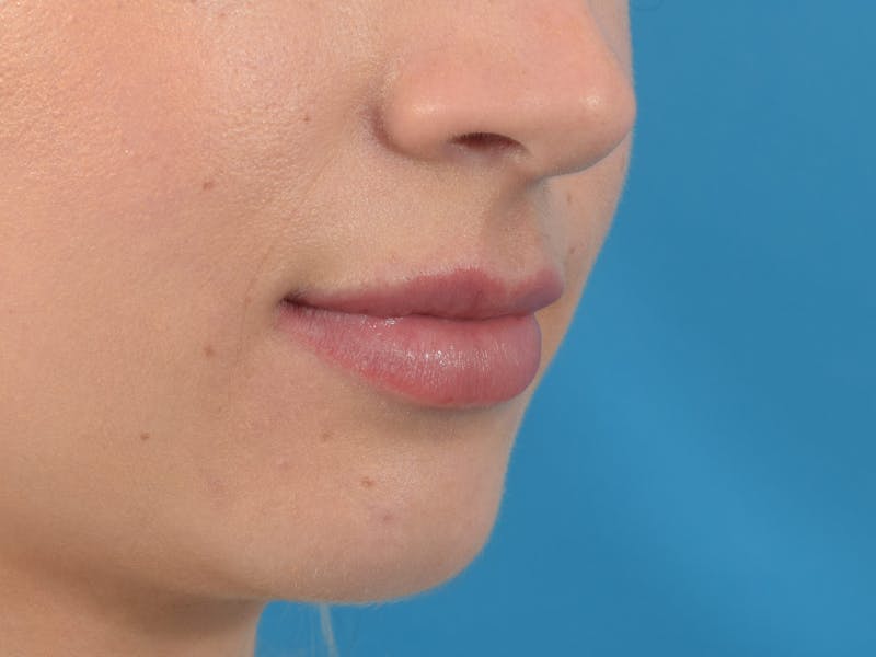 Filler - Lips Before & After Gallery - Patient 36543182 - Image 4
