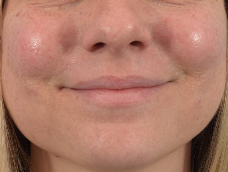 Filler - Lips Before & After Gallery - Patient 36543183 - Image 1