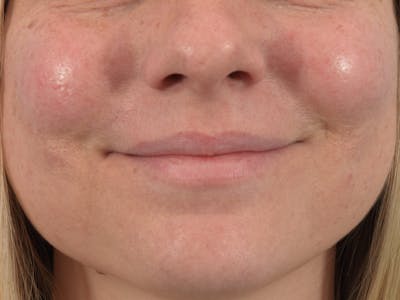 Filler - Lips Before & After Gallery - Patient 36543183 - Image 1