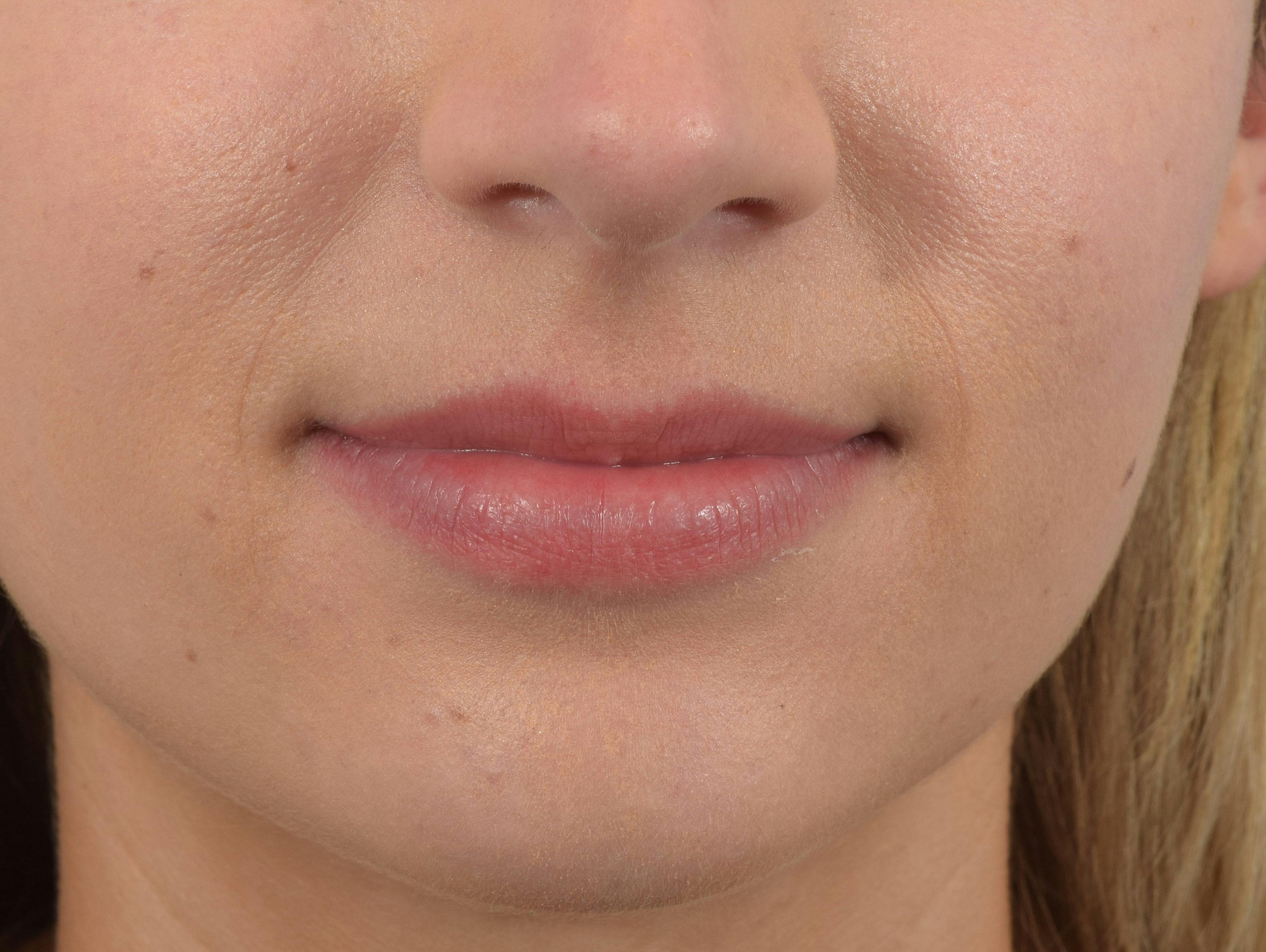 Lip Augmentation