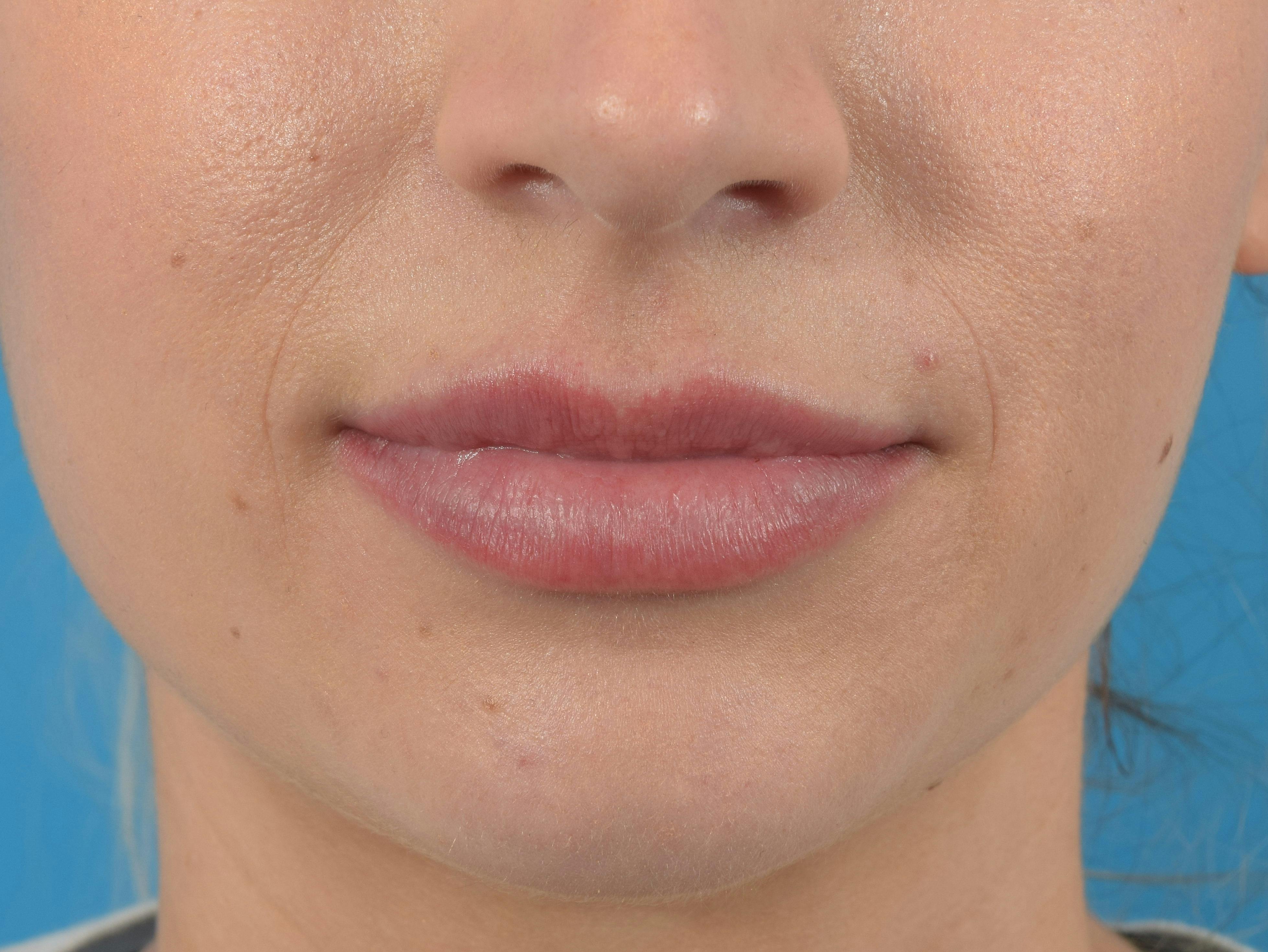 Lip Augmentation