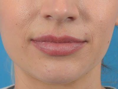 Filler - Lips Before & After Gallery - Patient 36543182 - Image 2
